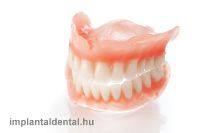 Implantaldental_protézis_kivehető_web.jpg  