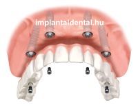 Implantaldental_protézis_rögzített_web.jpg  